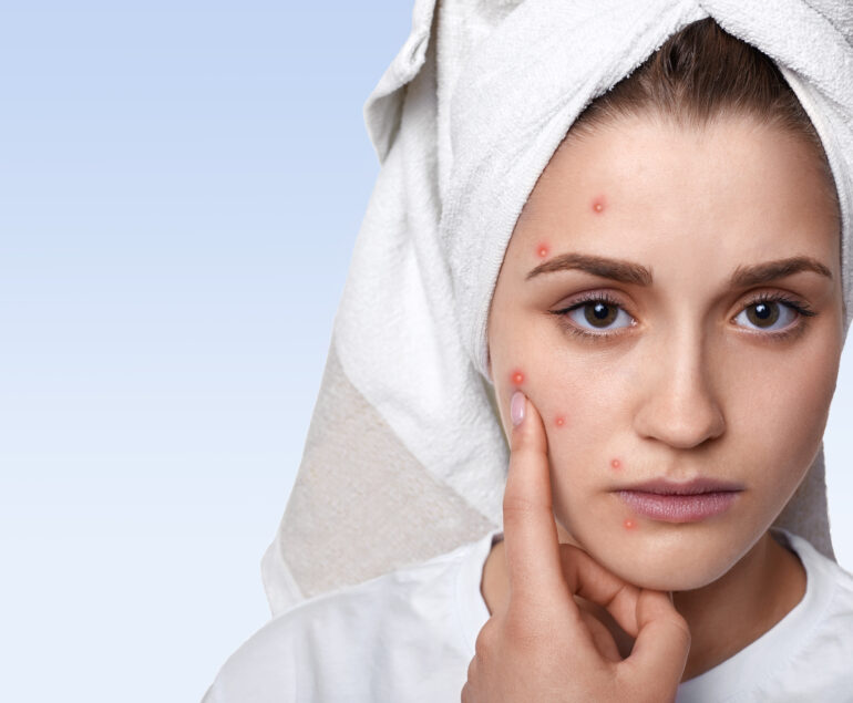 You can discover acne treatment near me options, acne scars cream at our specialty pharmacy.