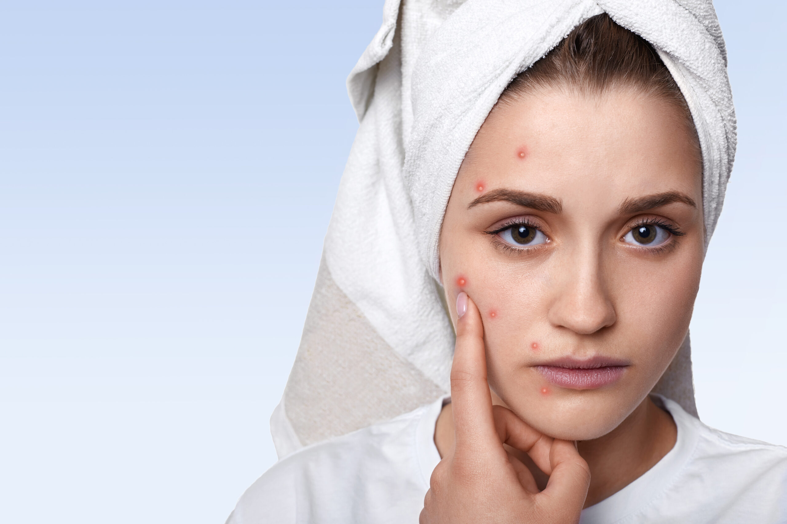 You can discover acne treatment near me options, acne scars cream at our specialty pharmacy.